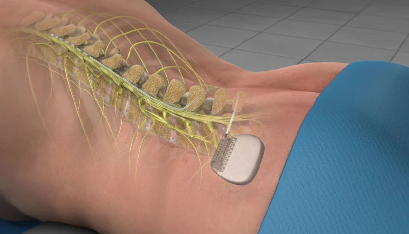 Spinal Cord Stimulation - TAAC